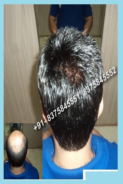 Hair Fixing in Delhi | Temporary & Permanent Hair Fixing in Delhi